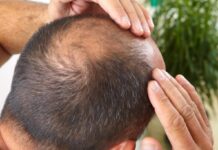 FUE hair transplant in India
