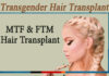 Transgender Hair Transplant- MTF and FTM Hair Transplant