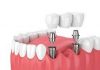 A Systematic View Of Dental Implants