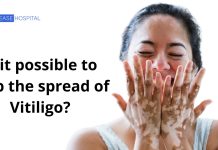 vitiligo - postingtree