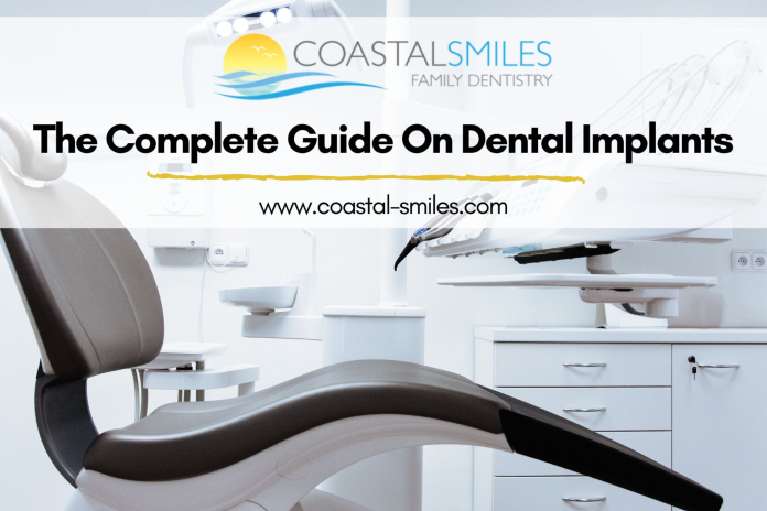 The Complete Guide On Dental Implants