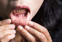 mouth cancer symptoms