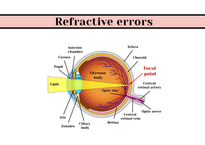 Types of refractive error featured image