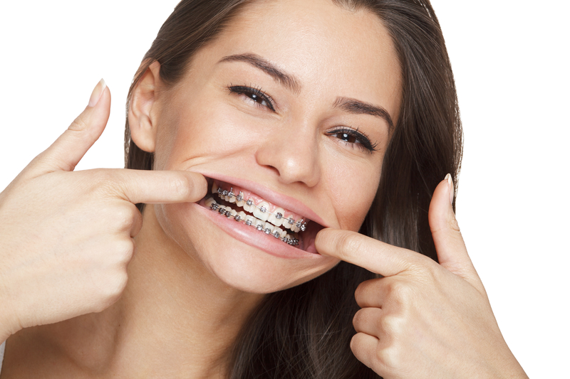 fast braces pros and cons